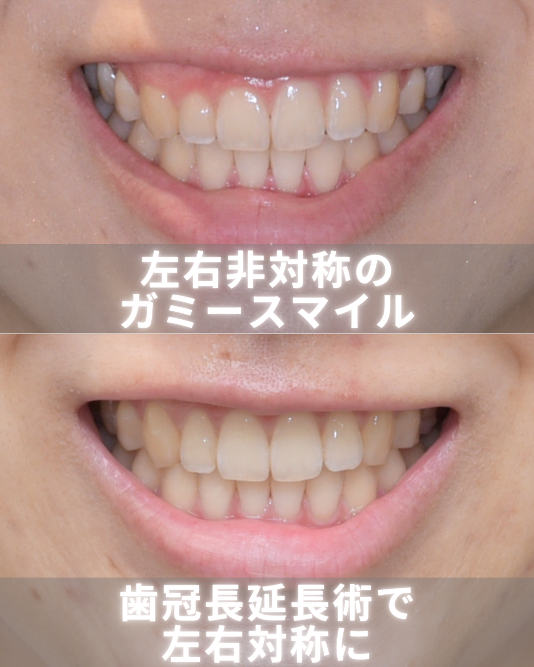 image_tooltip 左右非対称のガミースマイル症例