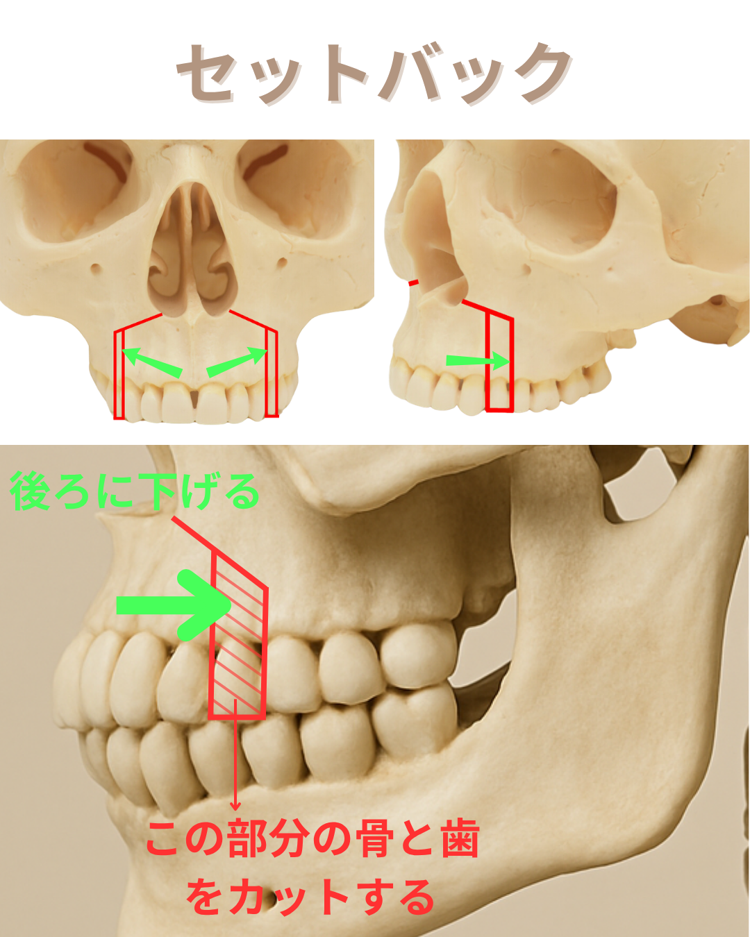 image_tooltip セットバック手術