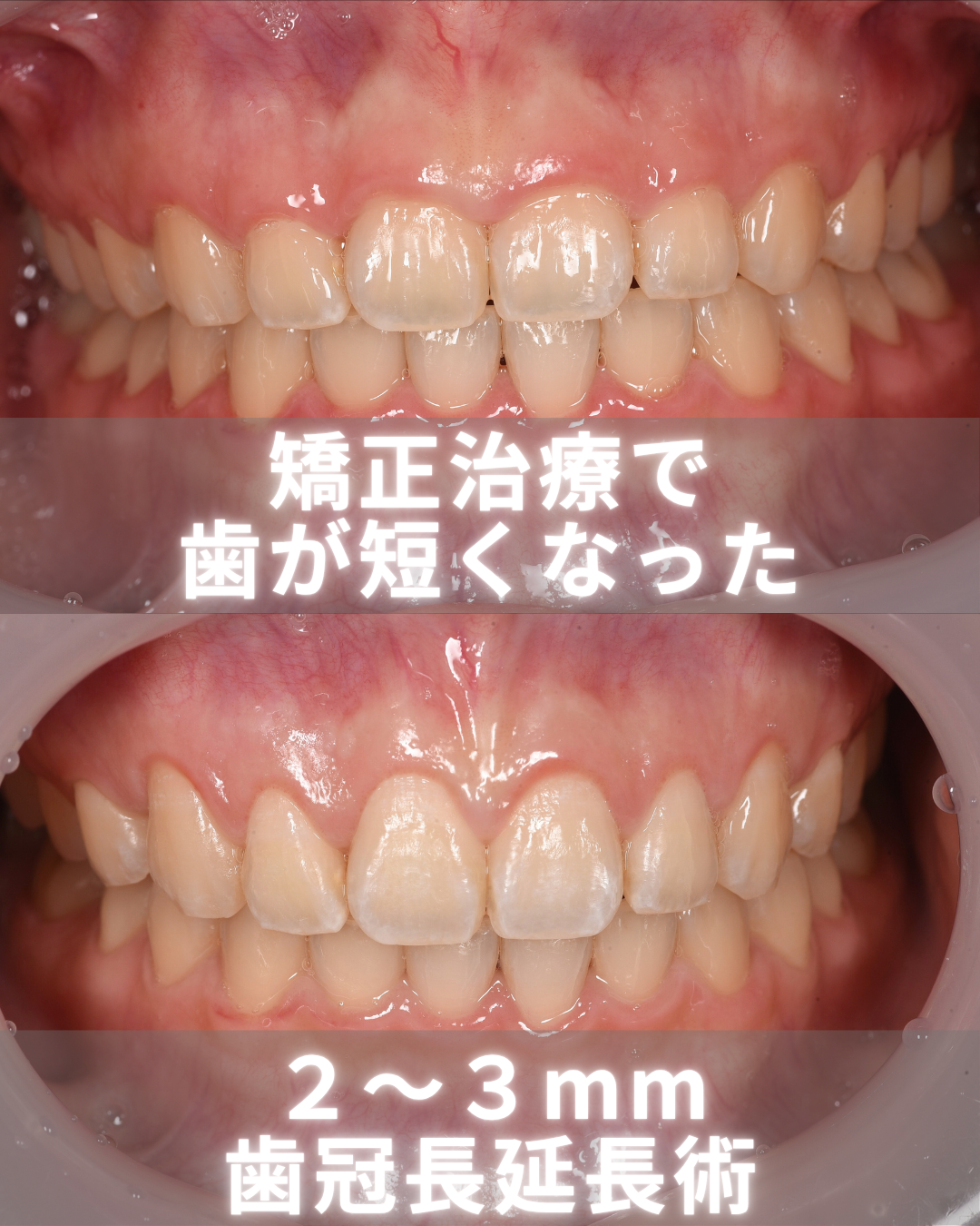 image_tooltip 歯冠長延長術