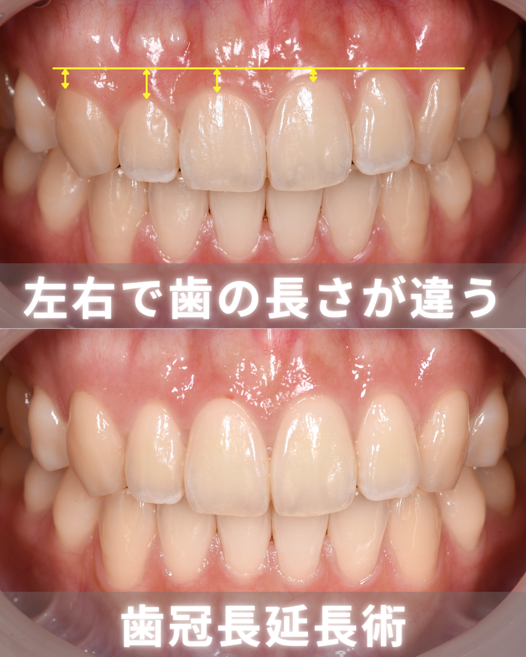 image_tooltip 歯冠長延長術によって改善した症例