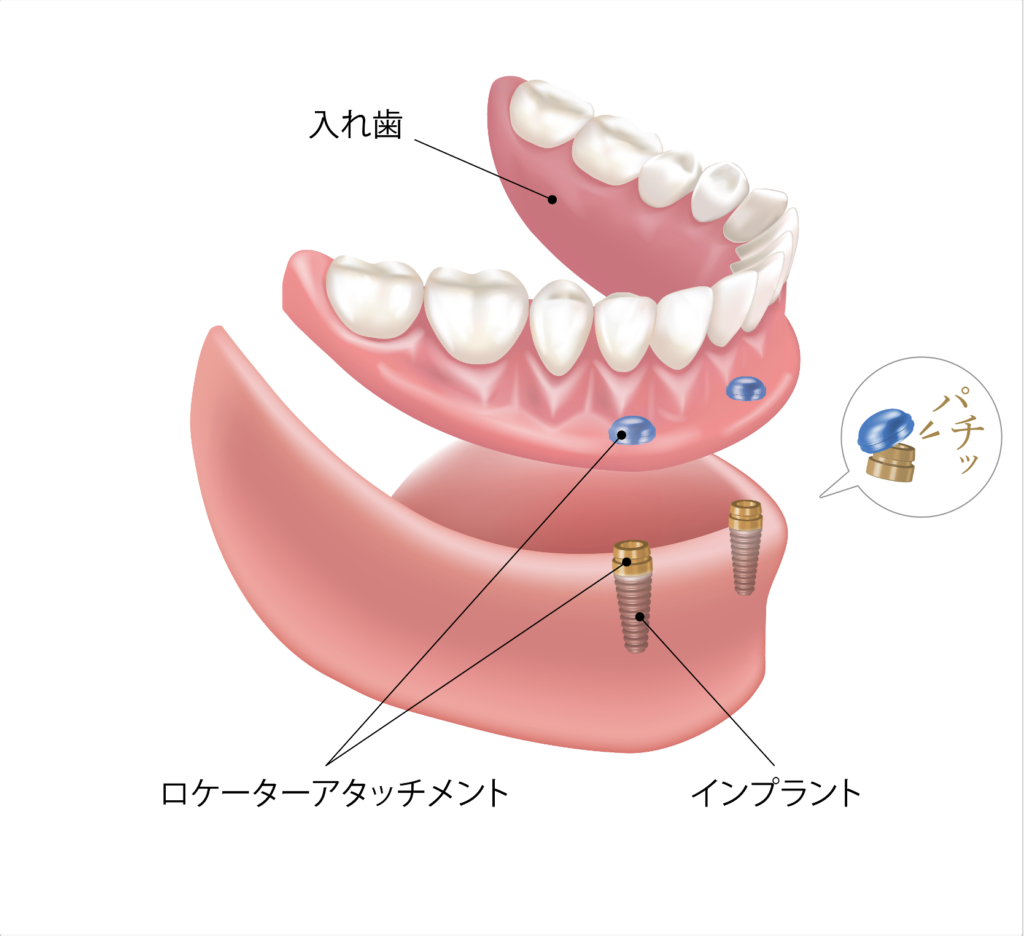 インプラントオーバーデンチャーのアタッチメントの種類について