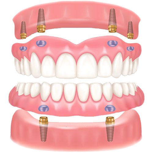 implant-over-denture