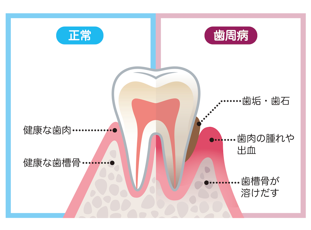 特徴②：歯周病が進行している
