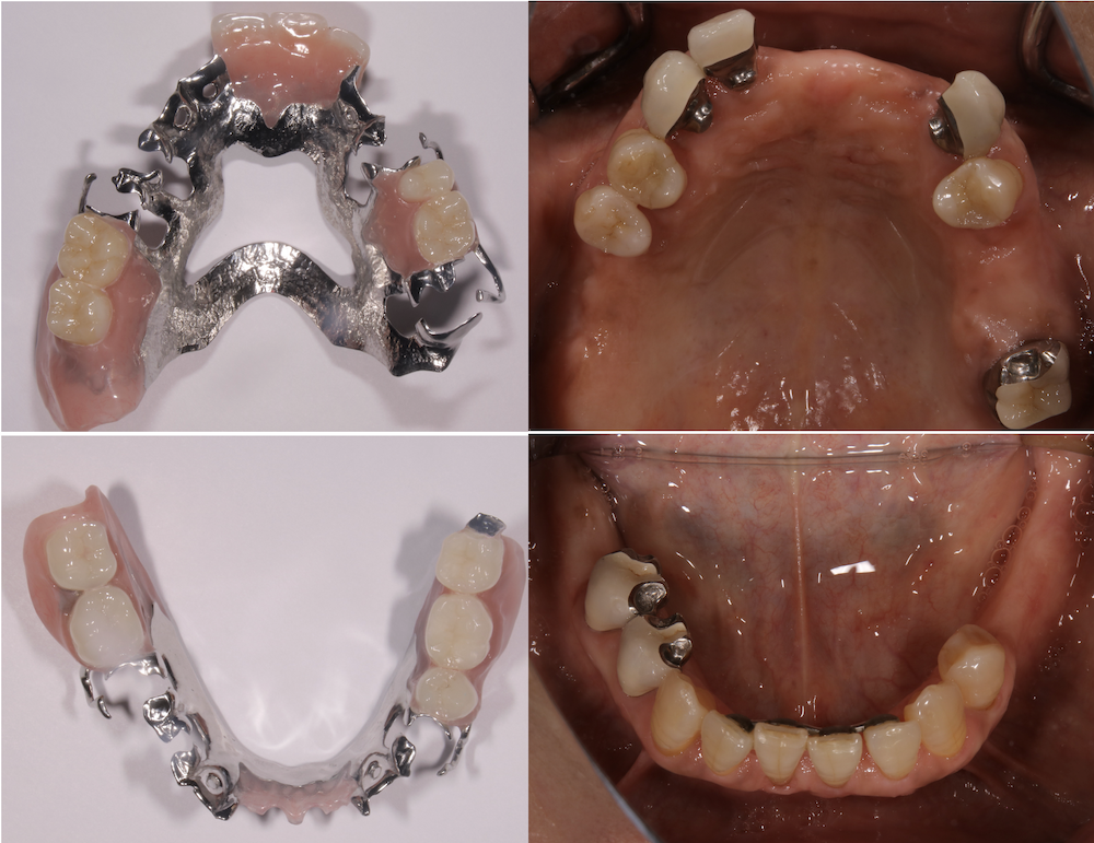 金属床義歯（部分入れ歯）