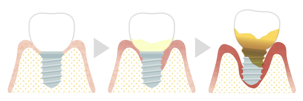 インプラント周囲炎の進行度と症状