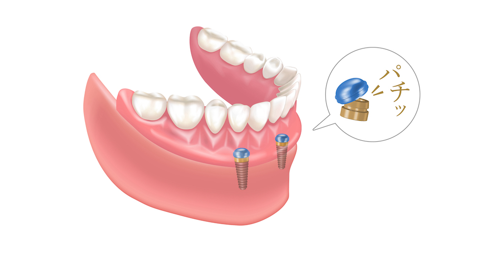 複数歯の治療はインプラントオーバーデンチャーがおすすめ