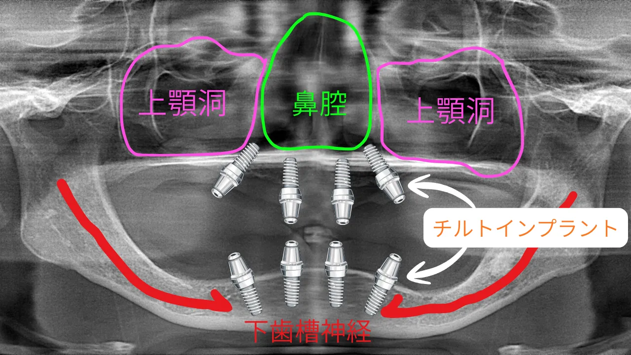チルトインプラント