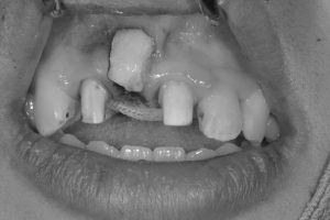 前歯の歯茎への歯肉移植の症例写真