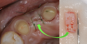 上顎の内側から採取した歯肉を陥没した歯茎に移植した際の症例写真