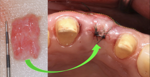 上顎の内側から採取した歯肉が凹んだ箇所に移植された直後の症例写真