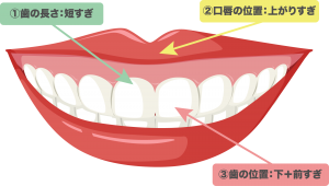 笑うと１０mmの歯茎の露出がある重度ガミースマイルを治療した症例 上唇粘膜切除術 天王寺区 四天王寺前夕陽ヶ丘 の歯医者 ヤスデンタルクリニック