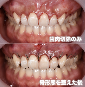 正常よりも歯が３mmほど短いガミースマイルを治療した症例 歯冠長延長術 天王寺区 四天王寺前夕陽ヶ丘 の歯医者 ヤスデンタルクリニック