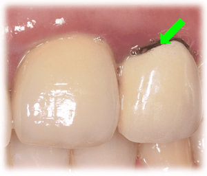 歯茎が黒い原因③：被せ物の金属フレームが見えている（メタルマージン）