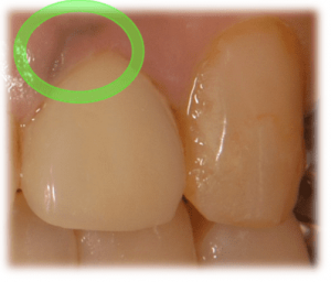 歯茎が黒い原因④：金属イオンが歯茎に沈着している（メタルタトゥー）