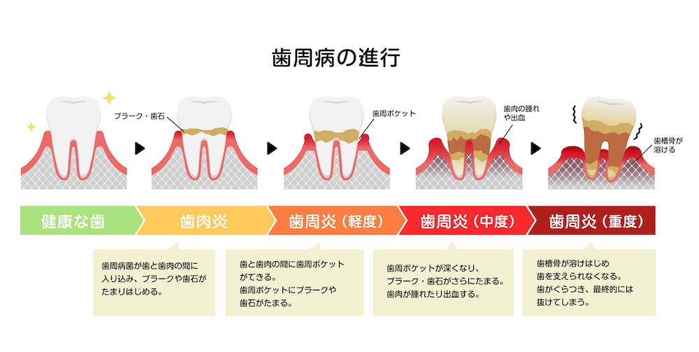 歯周病とは？見た目・匂いで気づく前に知る基本