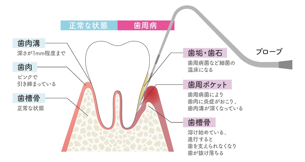 歯周病とは？まず知っておきたい基礎知識