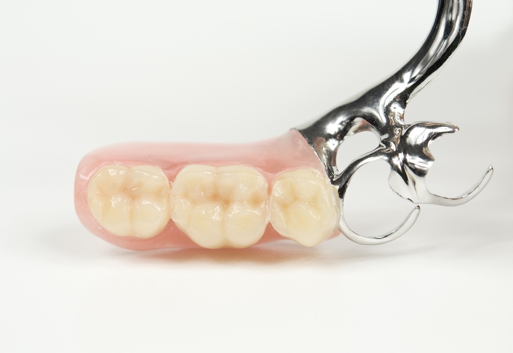 部分入れ歯の金具を自力で隠したいときのセルフケアと注意点