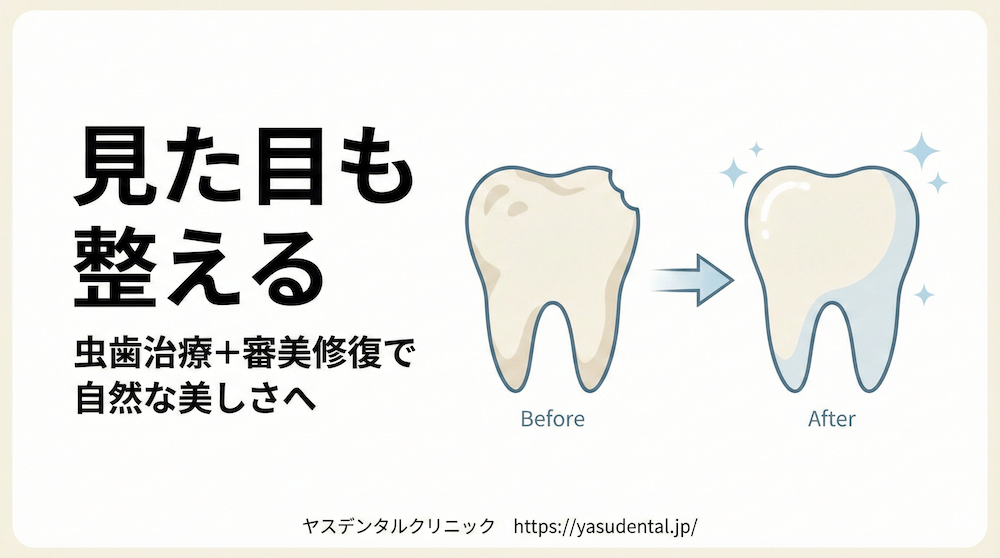 虫歯で見た目が気になるとき|審美修復と「セラミック矯正」という選択肢