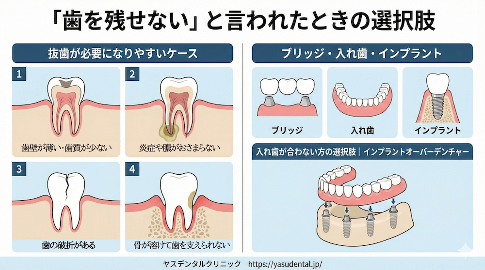 「歯を残せない」と言われたときの選択肢