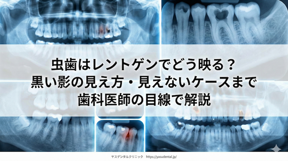 虫歯はレントゲンでどう映る？黒い影の見え方・見えないケースまで歯科医師の目線で解説