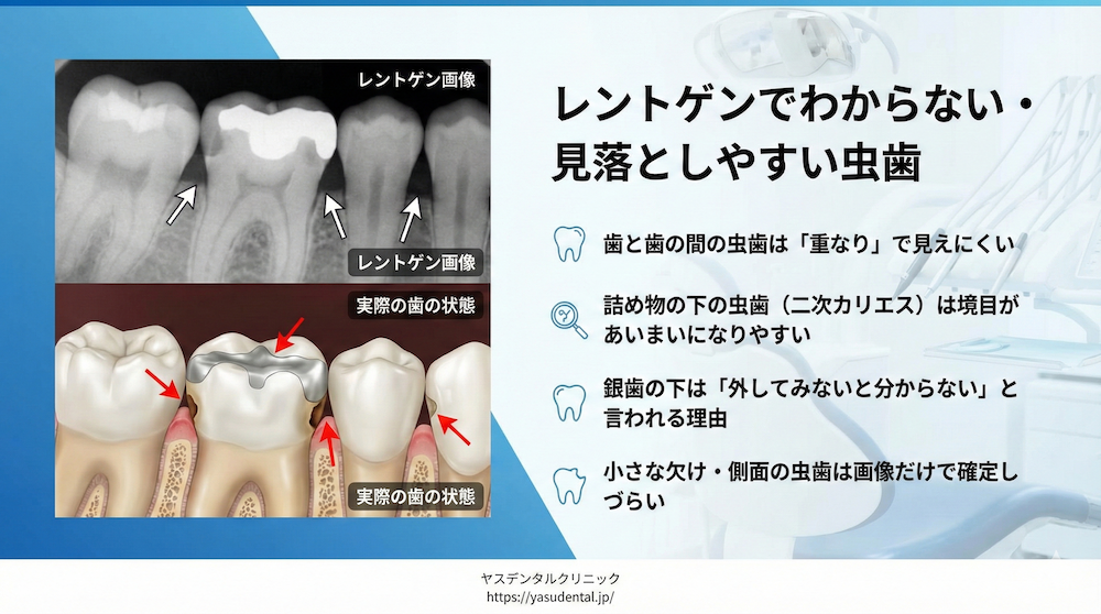 レントゲンでわからない・見落としやすい虫歯