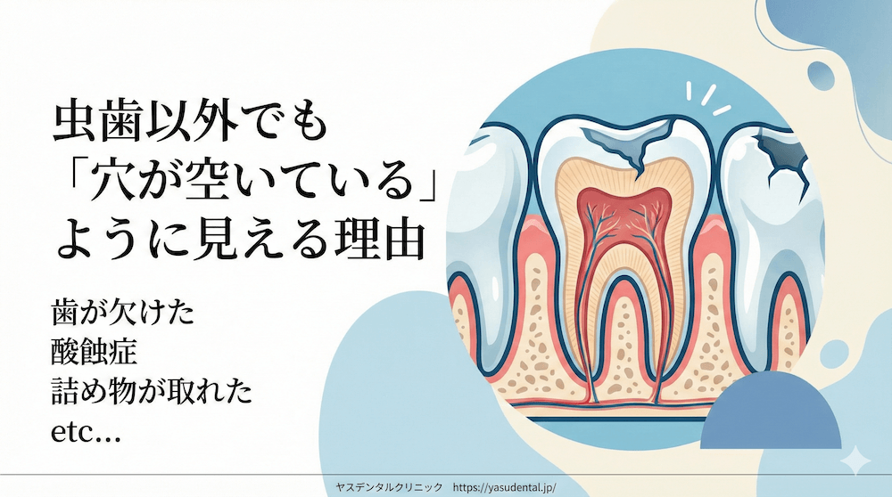 虫歯以外でも「穴が空いている」ように見えることがあります