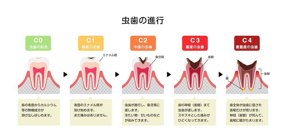 進行段階（C0〜C4）別｜1ヶ月で起こり得る変化と症状の目安