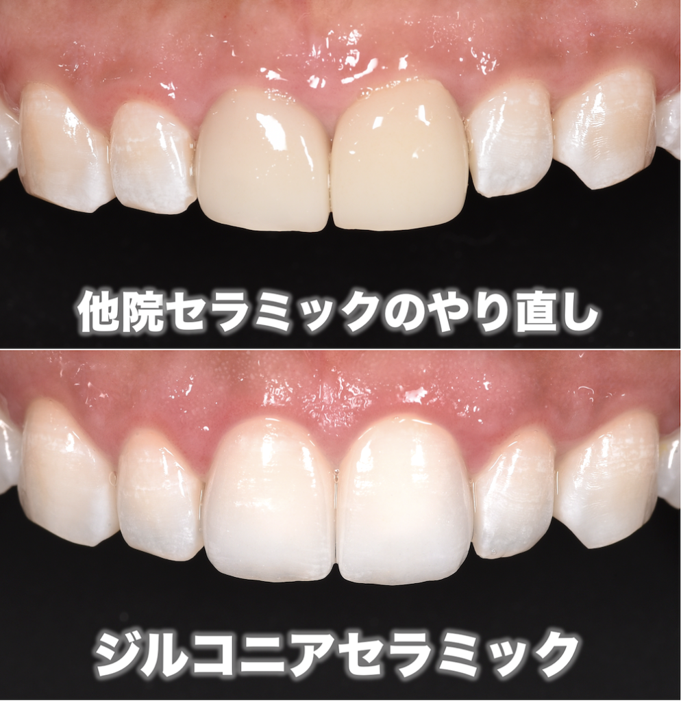 他院のセラミック治療のやり直しを行った症例 | 大阪でセラミック矯正をするなら「ヤスデンタルクリニック」