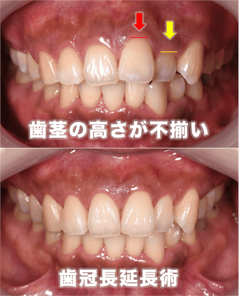 ④歯茎の高さが揃っていない