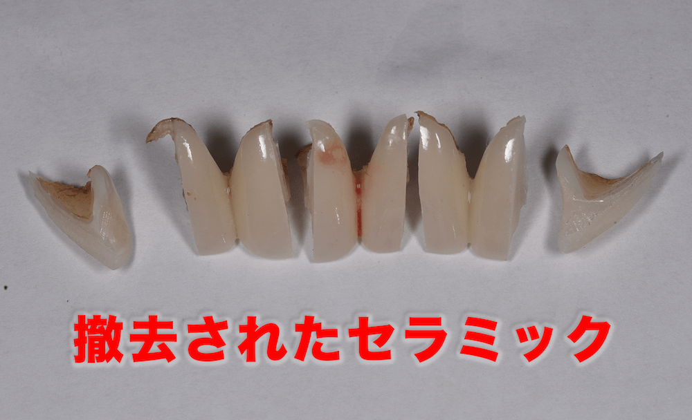 セラミックの色・形の失敗例と解決策