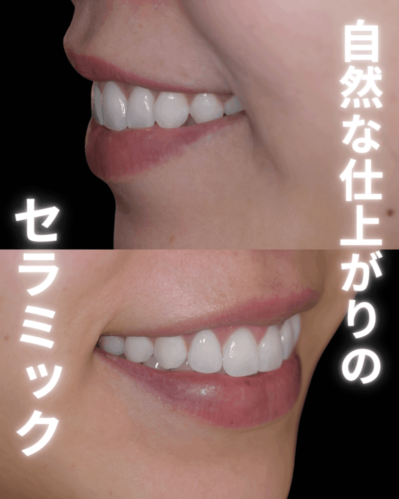 自然なセラミックを入れるための3つの方法