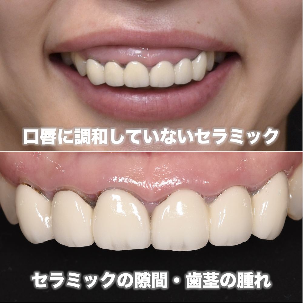 前歯6本のセラミック治療の費用はどれくらい？ | 大阪でセラミック矯正をするなら「ヤスデンタルクリニック」