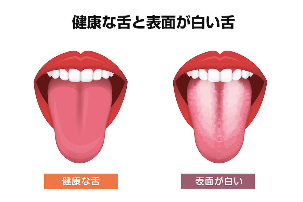 舌苔（ぜったい）による口臭