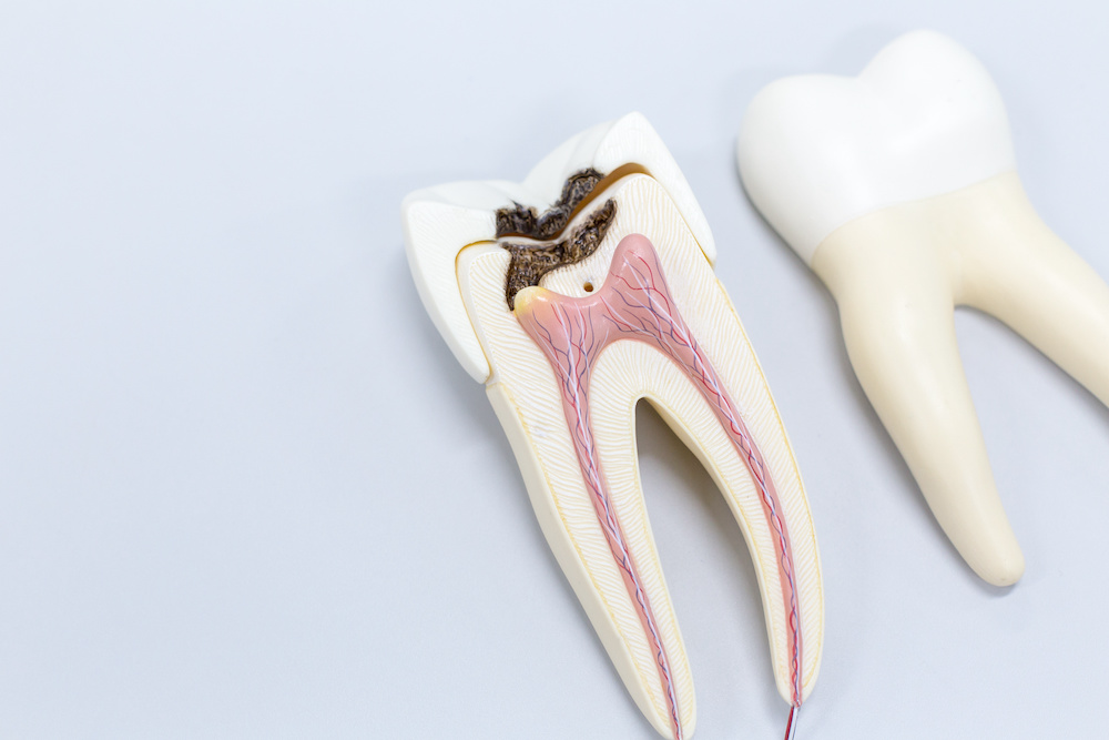 ③虫歯（二次カリエス）や歯周病の進行