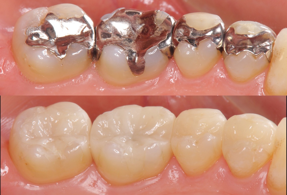 銀歯とセラミック、どちらがおすすめ？特徴やメリット・デメリットを解説