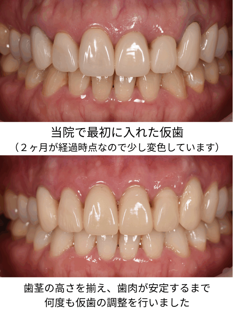 前歯 セラミック 後悔