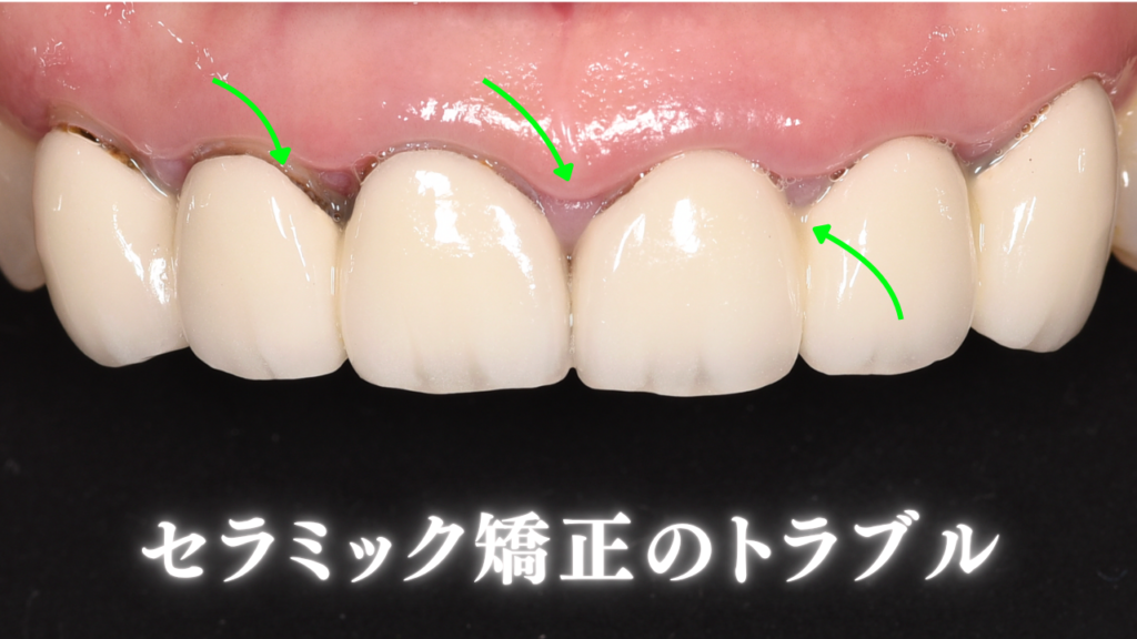 image_tooltip セラミック矯正のトラブル