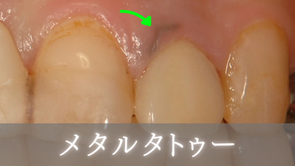 image_tooltip メタルタトゥー