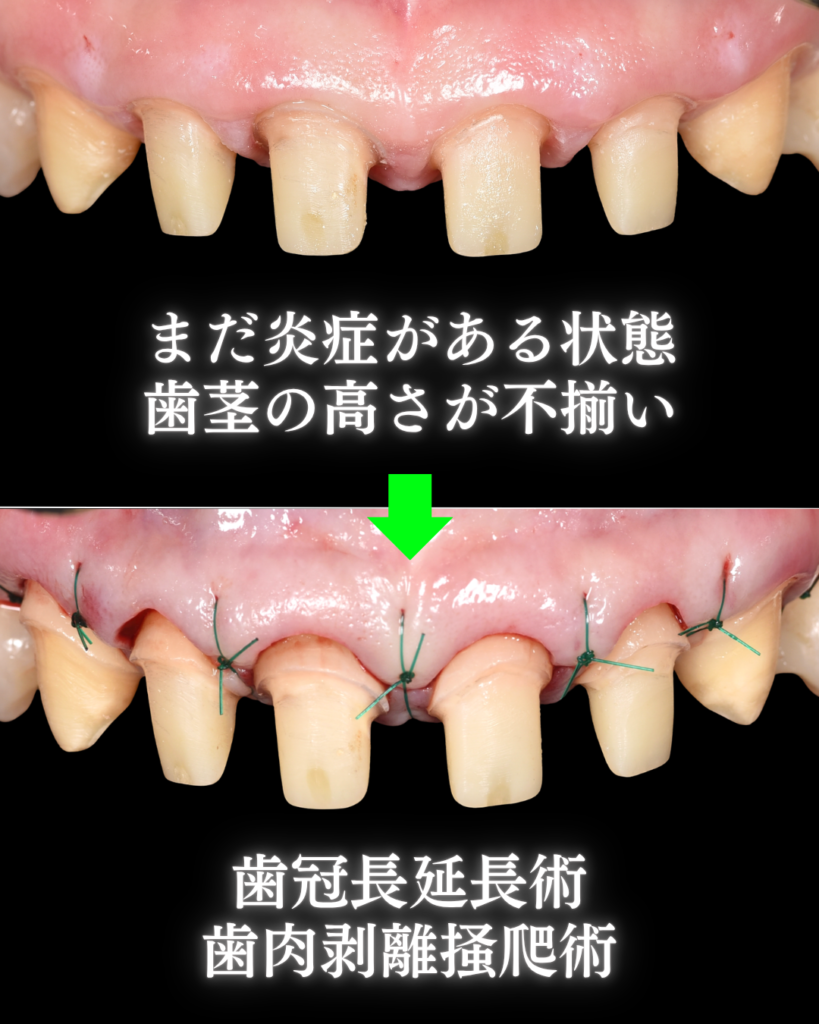 image_tooltip 歯冠長延長術
歯肉剥離搔爬術