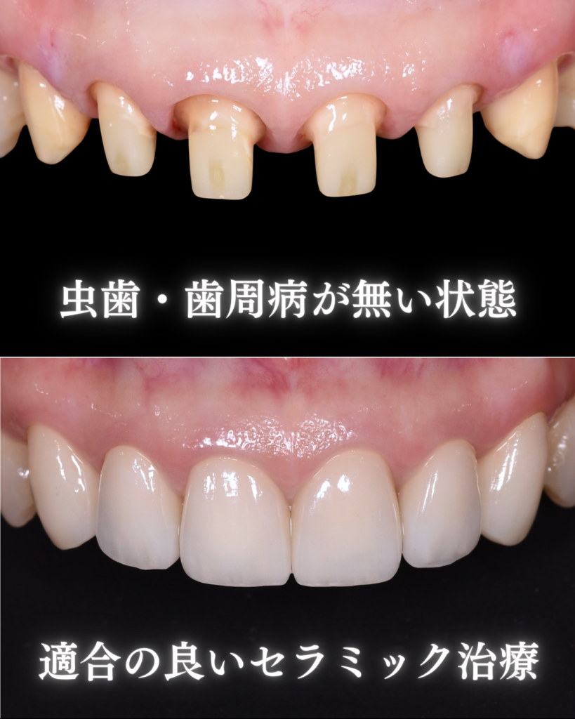 image_tooltip 虫歯・歯周病がない状態
適合の良いセラミック
