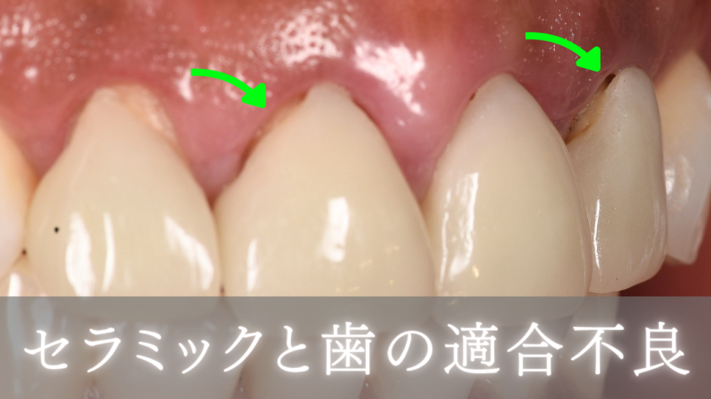 image_tooltip セラミックと歯の適合不良