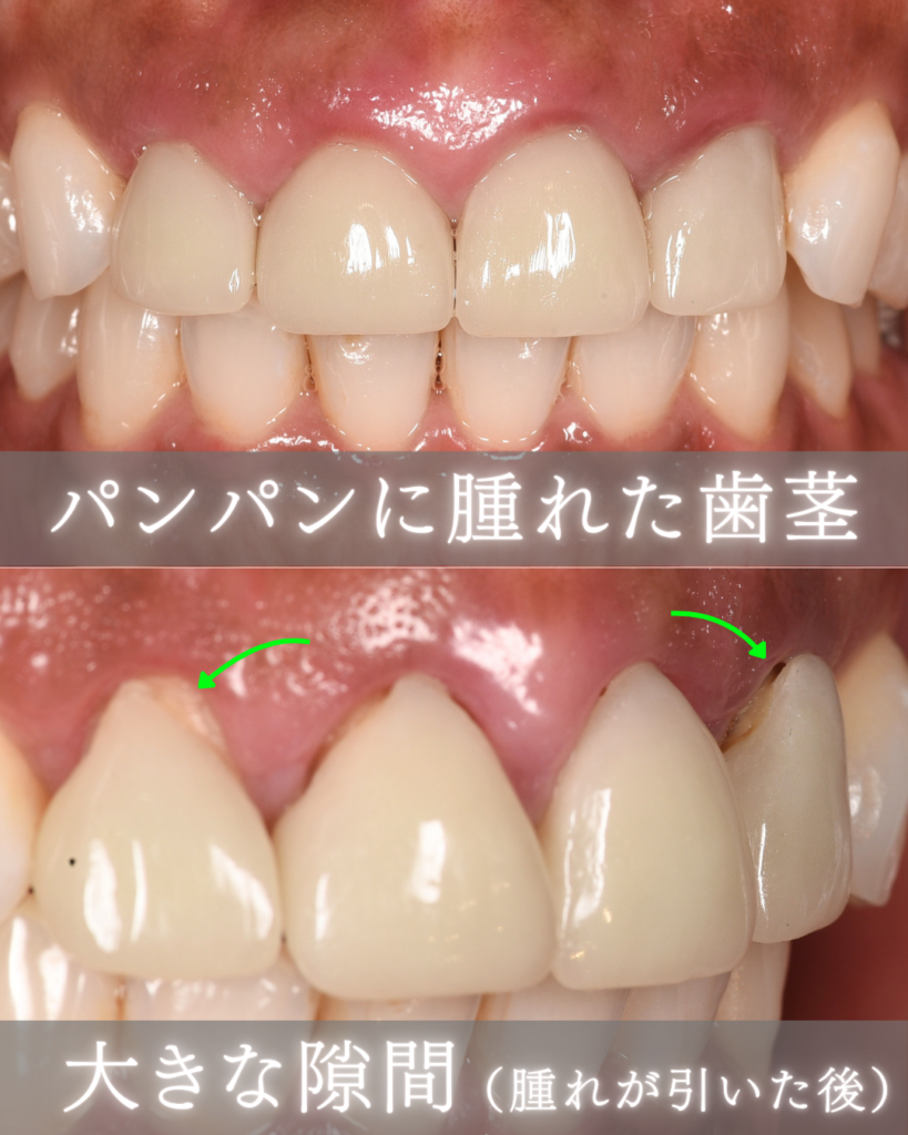 image_tooltip パンパンに腫れた歯茎
大きな隙間
