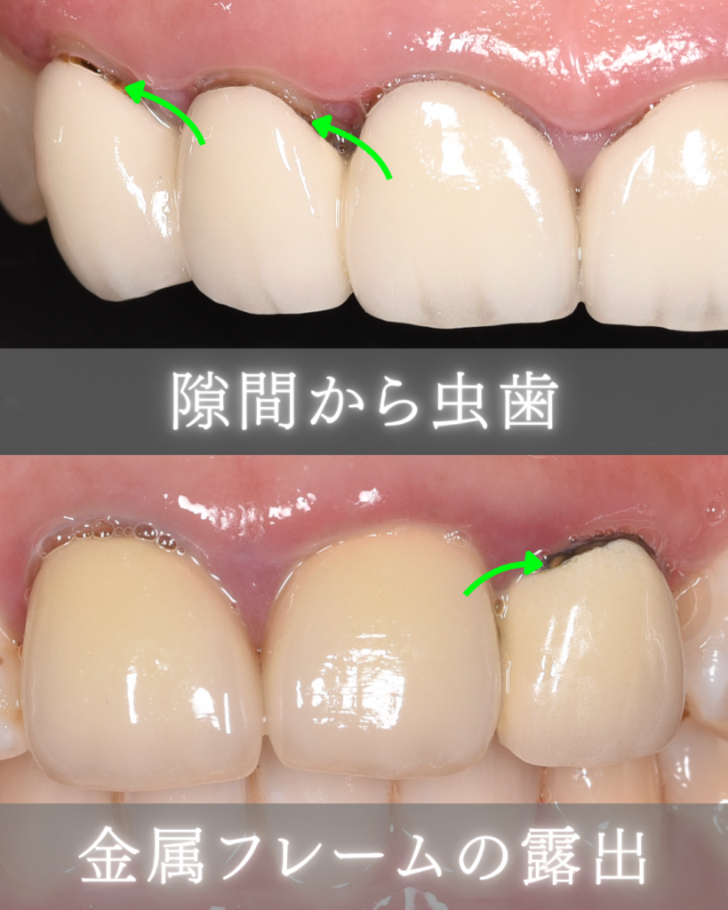 image_tooltip 隙間から虫歯
金属フレームの露出