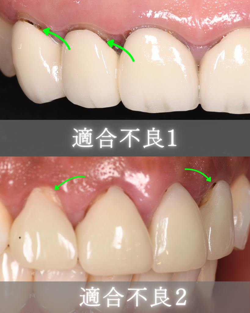 image_tooltip 適合不良