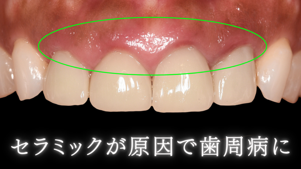 image_tooltip セラミックが原因で歯周病に