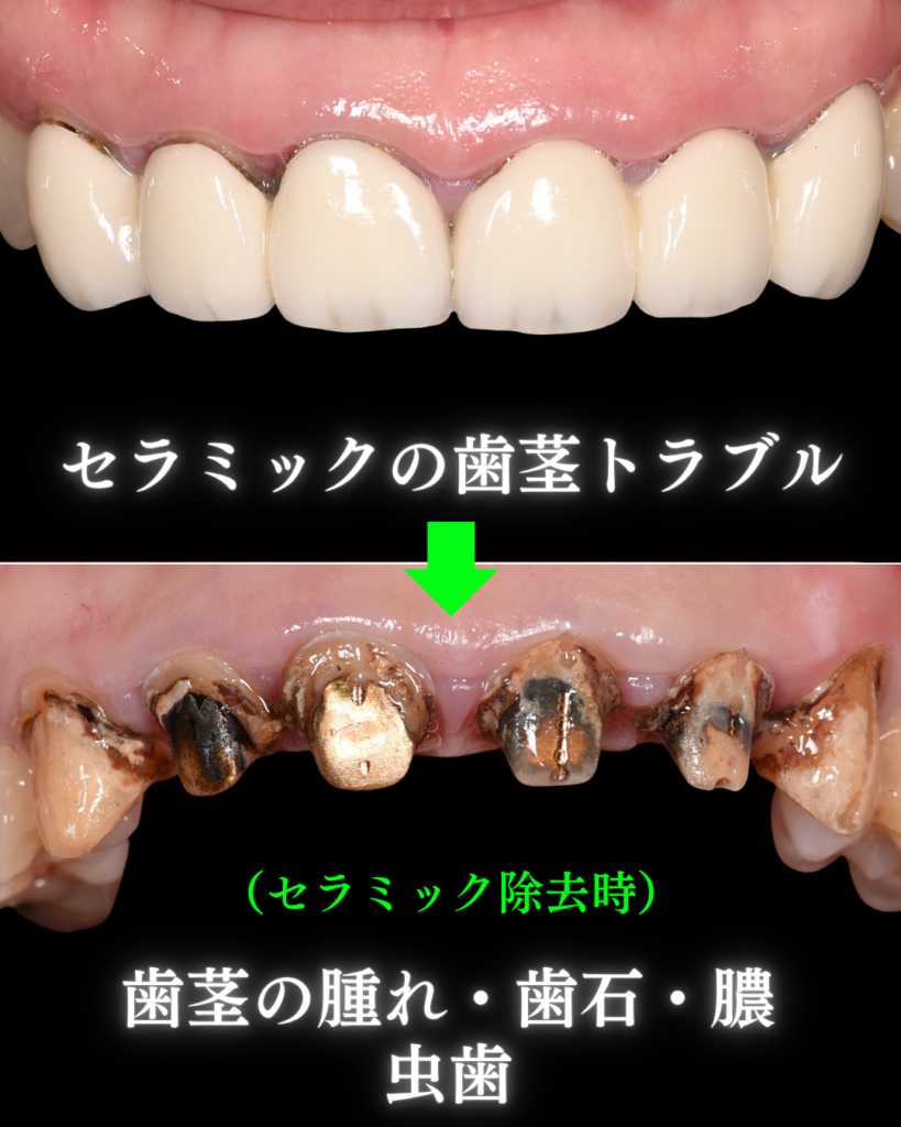 image_tooltip セラミック治療の歯茎トラブル