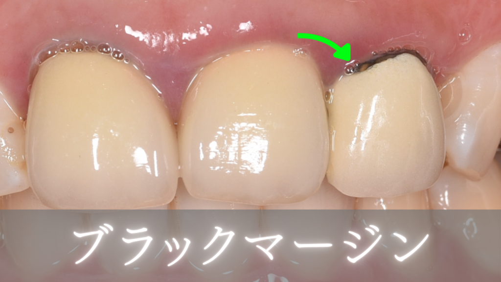 image_tooltip ブラックマージン