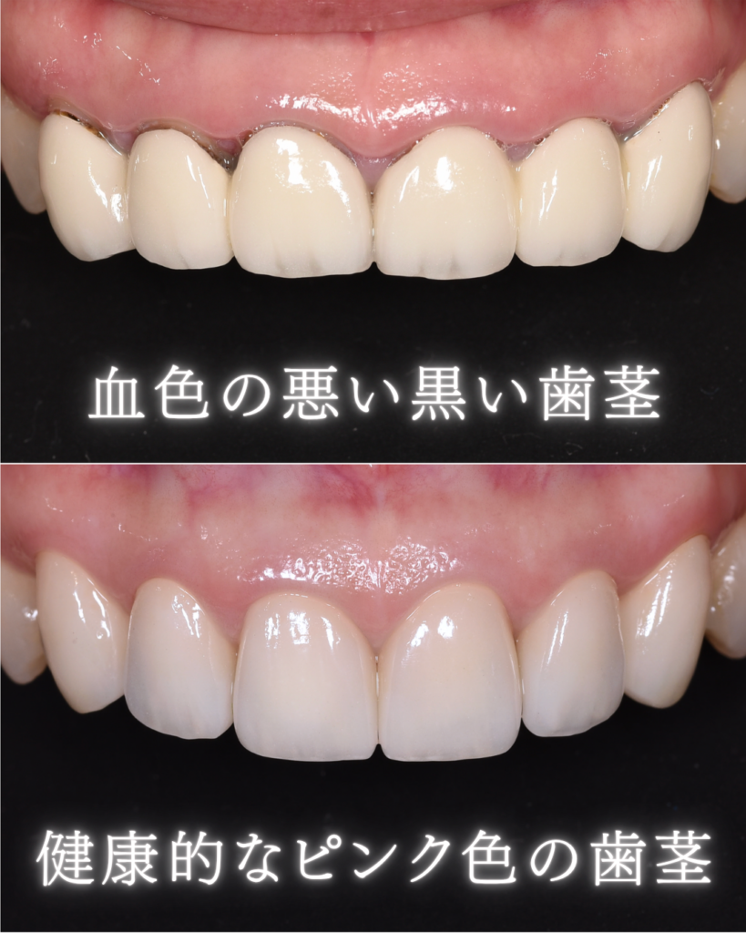 image_tooltip 血色の悪い黒い歯茎
健康的なピンクの歯茎