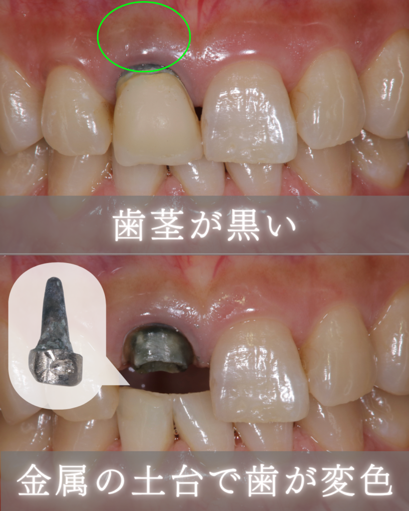 image_tooltip 歯茎が黒い
金属の土台で歯が変色