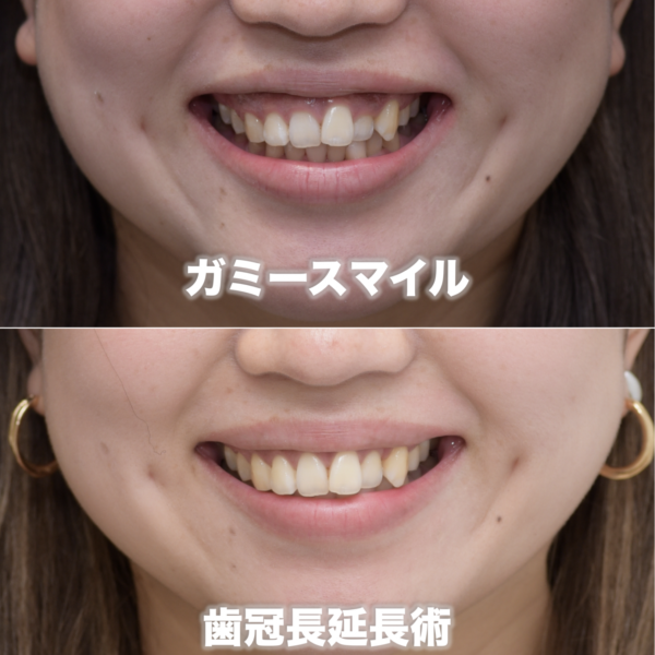 歯茎の高さが異なるガミースマイルを治療した症例（歯冠長延長術）